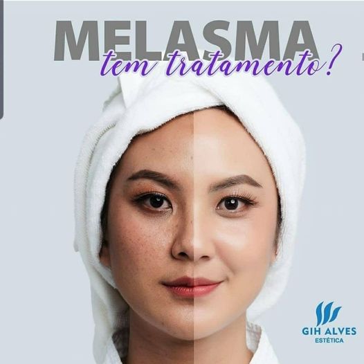 Melasma