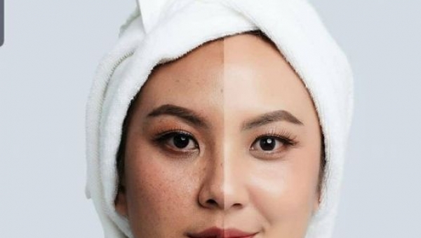 Melasma